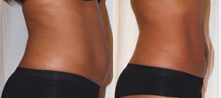 Inch Loss Before and After 07